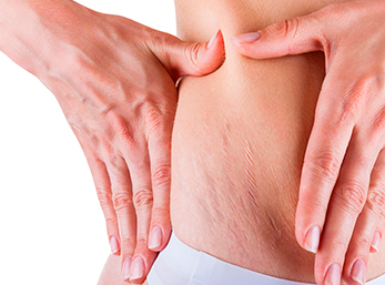 Mesoterapia estrias em Curitiba